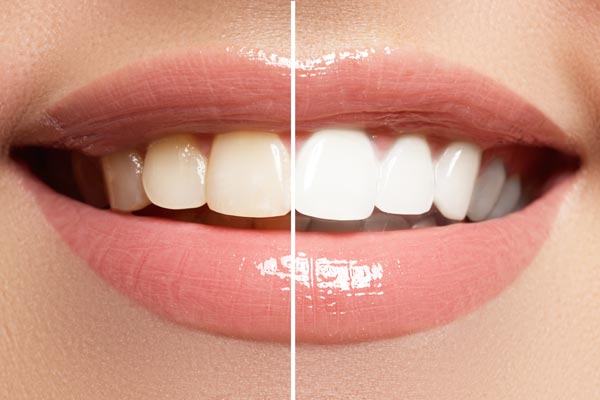 Ästhetische Zahnheilkunde von Dr. Stephanie Flaig, Zahnärztin München